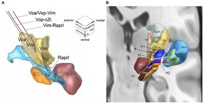 A Single DBS-Lead to Stimulate the Thalamus and Subthalamus: Two-Story Targets for Tremor Disorders